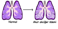 Akut Akciğer Ödemi Belirtileri ve Tedavisi Akut Akciğer Ödemi Belirtileri ve Tedavisi