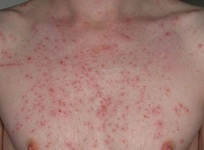 Akut Ürtiker Belirtileri ve Tedavisi Akut Ürtiker Belirtileri ve Tedavisi