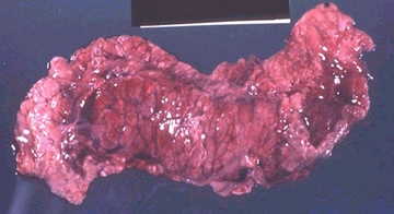 Akut Pankreatit Belirtileri ve Tedavisi